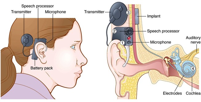 In the photo above, you will find the parts of a cochlear implant and how it interacts with the cochlea to help users hear. Source: https://www.medgadget.com
